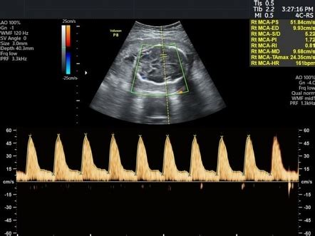 Fetal Middle Cerebral Arterial Doppler Assessment Radiology Reference