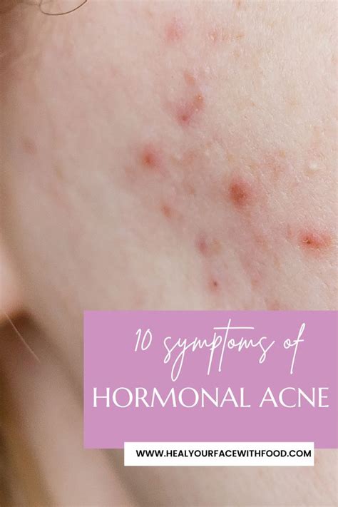 Managing Hormonal Acne Artofit