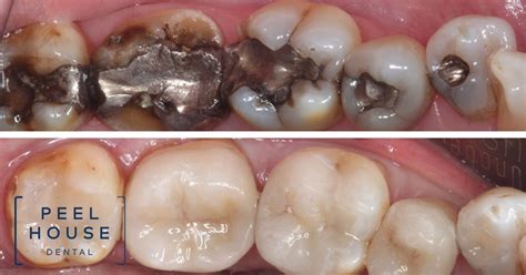 Peelhouse Dental Care The Downside To Amalgam Fillings