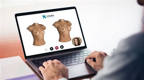 Crisalix D Simulation For Your Plastic Surgery In Lima Peru