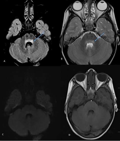 EV 71 encephalitis. 3 year old with fever, headache and altered ...