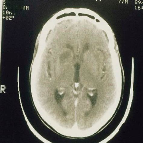 Ct Scan Showing A Temporo Occipital Ischemic Infarction As A Presenting Download Scientific