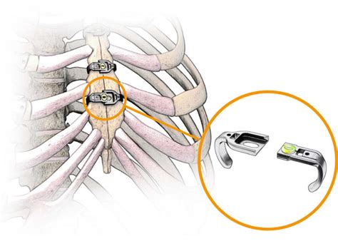 CardioThoracic