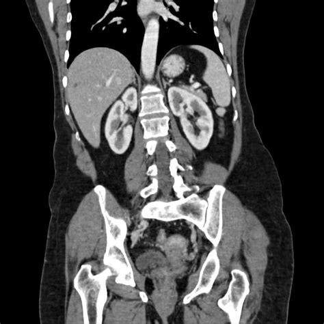 Calcified Hydatid Cyst Of The Liver Image