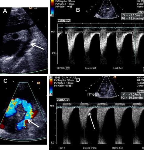 Suprasternal Notch Echo