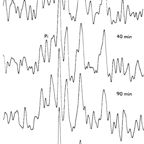 31p Magnetic Resonance Spectroscopy Spectra Ob­ Tained In Vivo Prior To Download Scientific