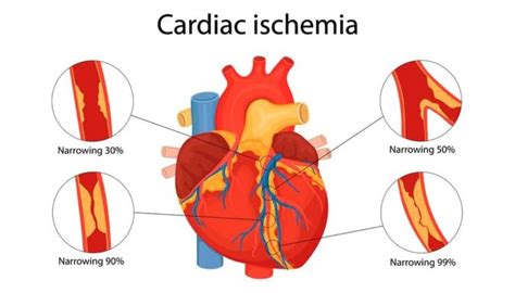 Angina: Symptoms, Causes and Types - Dr Website