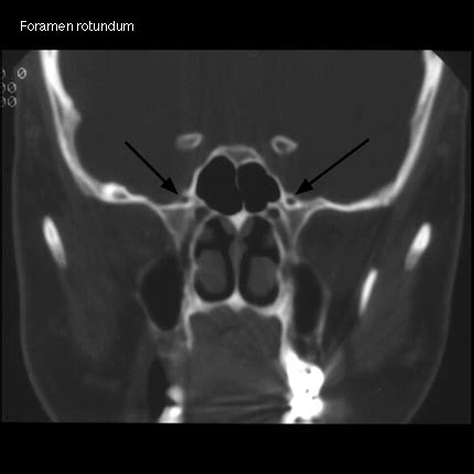 Foramen Rotundum Ct Scan