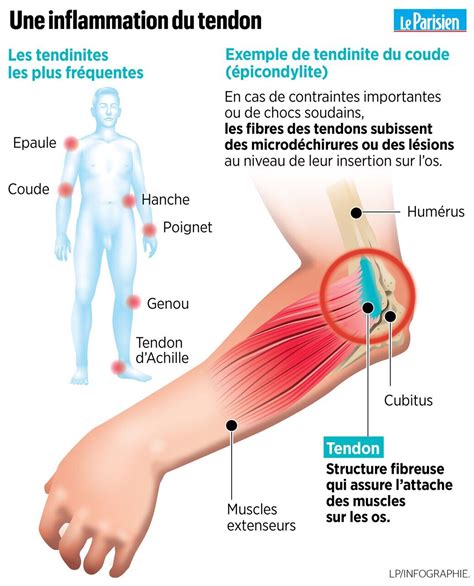 Tendinite Avant Bras Comment La Soigner Rapidement Avant Bras