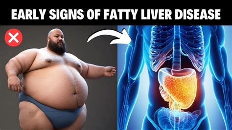 Fatty Liver Symptoms Early Signs Of Fatty Liver Disease Non Alcoholic Fatty Liver Disease