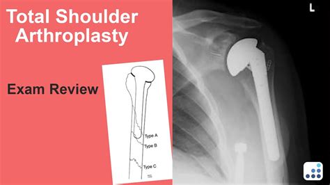 Total Shoulder Arthroplasty Exam Review Anthony Romeo Md Youtube