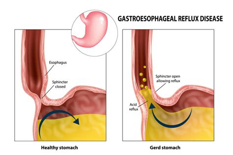 GERD or Heart Attack? - MD Knowledge - Health Journal