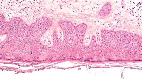 First Real World Report Of Near Complete Response With Cemiplimab In Penile Squamous Cell