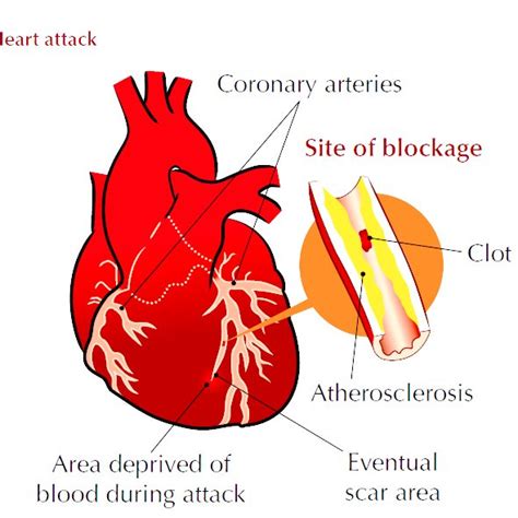 Myocardial Infarction Pathophysiology Diagram Myocardial Infarction