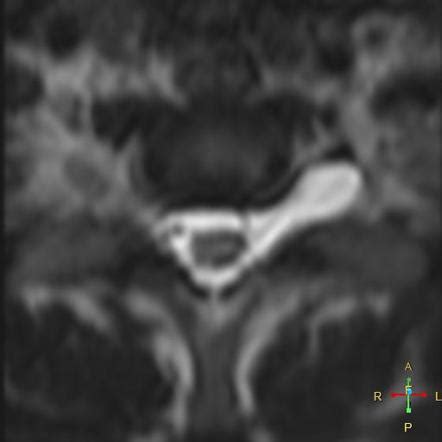 Brachial Plexus Injuries Radiology Reference Article Radiopaedia Org