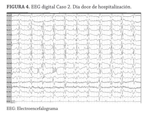 Eeg In Creutzfeldt Jakob Disease Day 12 Download Scientific Diagram