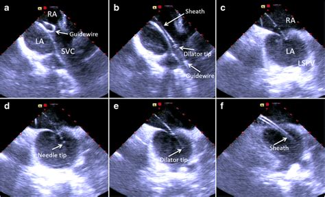 Intracardiac Echocardiography Guided Transseptal Puncture A