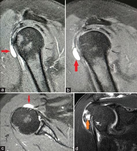 A Cystic Mass In The Long Head Of Biceps Abstract Europe Pmc