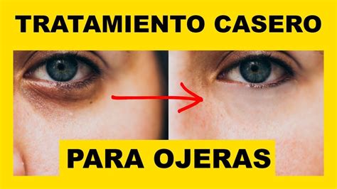 Elimina Las Ojeras En Minutos Trucos Caseros Que No Conocias Quedara