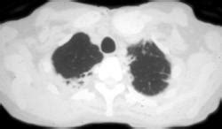 Radiation Induced Sarcoma Of The Clavicle Musculoskeletal Case