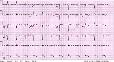 Atrial Flutter With 4 1 Conduction Example 2 Learn The Heart