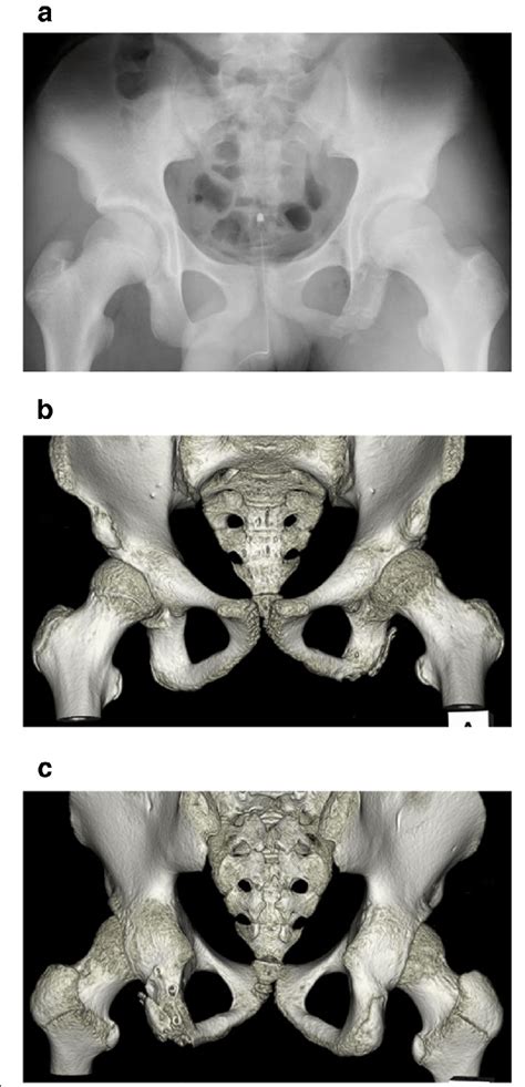 Postoperative Imaging Of The Pelvis A Plain Radiography B C