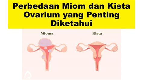 Perbedaan Miom Dan Kista Ovarium Yang Harus Kamu Ketahui Youtube