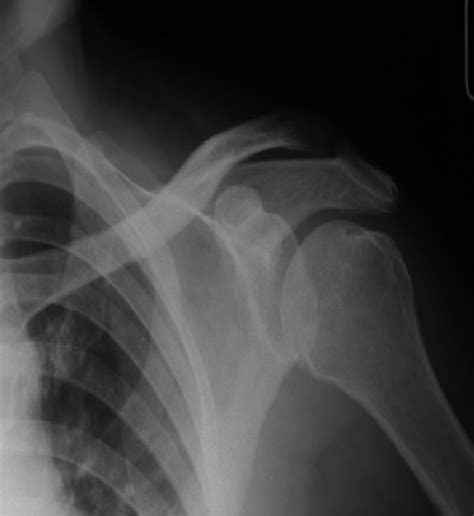 Radiograph of the left shoulder reveals subchondral cystic lesions in ...