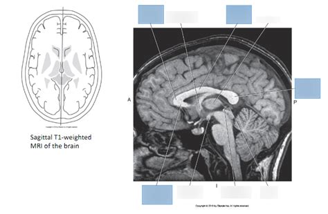 Sagittal T1 Brain MRI 3 Diagram | Quizlet