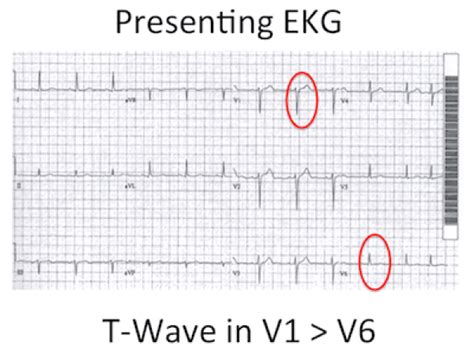 EKG Subtlety: Tall T-Wave in Lead V1