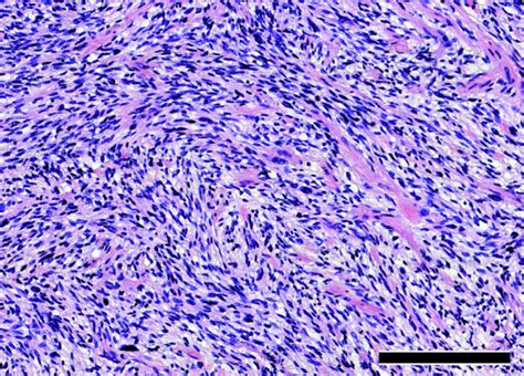 Histopathological Examination Revealed A Highly Cellular Tumor With