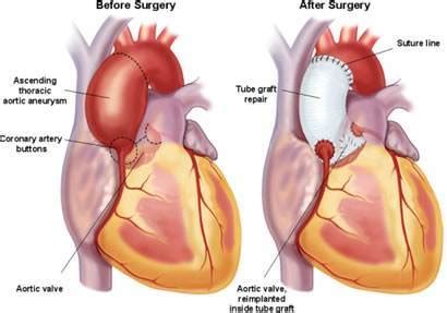 Aort anevrizmalarında tedavi