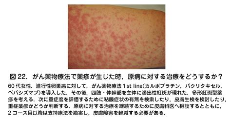 リンデロンvs 軟膏10g かぶれ かゆみどめ 塗り薬 強力 ステロイド 軟膏 強い 痒み 湿疹 皮膚 Six Matrix Jp