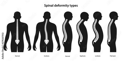 Vecteur Stock Spinal Deformity Types Anterior View And Lateral View Of