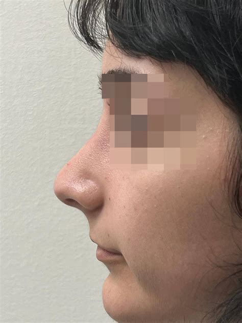 Structural Septo Rhinoplasty Nose Job Ent South West