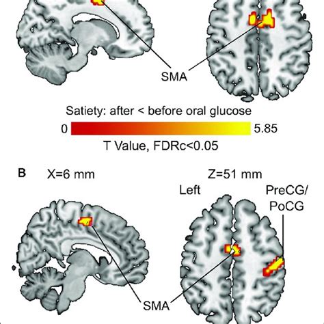 Before Vs After Glucose Administration On Brain Activity A Download Scientific Diagram