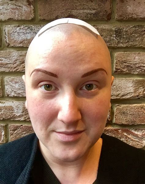 Living With Alopecia How To Accept Yourself Differences And All Artofit