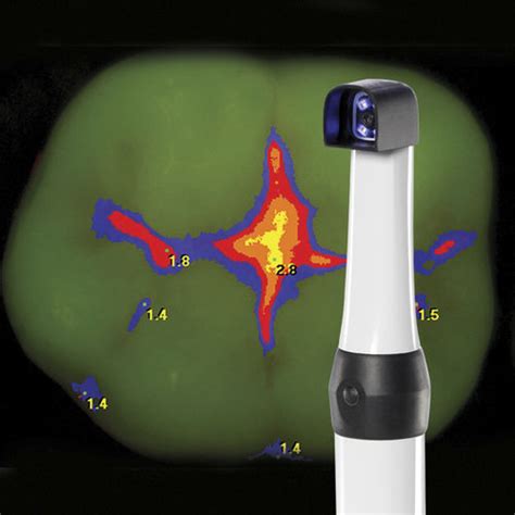 laser fluorescence caries detector camx spectra air techniques