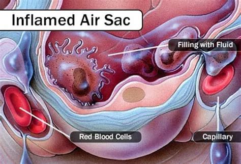 Qanda ‘white Lung Pneumonia What You Need To Know