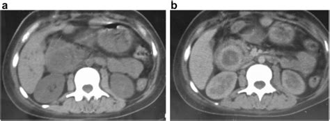 Computed Tomography Axial Ct Scans Of The Abdomen Before A And After