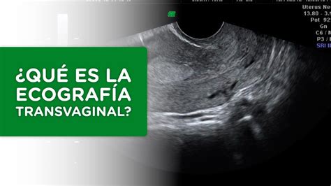 Qué es la Ecografía Transvaginal YouTube