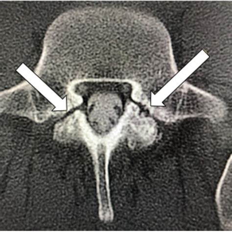 Computed Tomography Myelogram Axial View Demonstrated Bilateral L5 Download Scientific