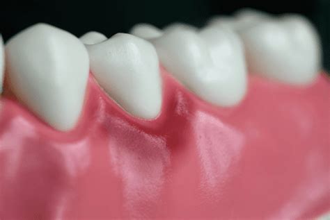 Cómo prevenir la aparición de gingivitis Clínica Dental Udaberri