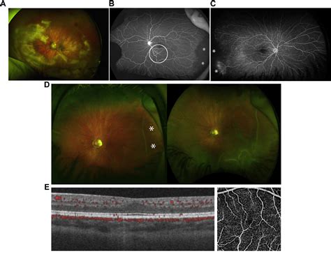 Figure 2 From International Classification Of Retinopathy Of Prematurity Third Edition