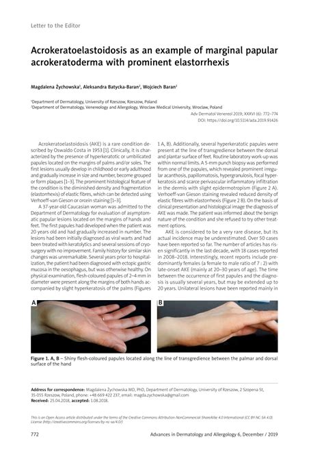 Pdf Acrokeratoelastoidosis As An Example Of Marginal Popular