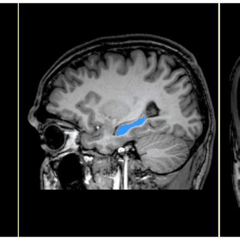 Cerebral Mri Depicting Manual Segmentation Of Hippocampus Figure Shows