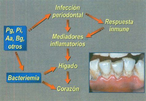 Mecanismos Inmunol Gicos De Las Enfermedades Periodontales Y