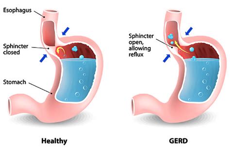 Reflux And Hiatal Hernias Total Upper Gi Surgery