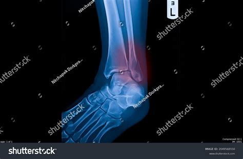 42 Lateral malleolus fracture Images, Stock Photos & Vectors | Shutterstock