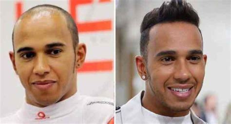 Celebrity Hair Loss Lewis Hamilton Hair Transplant Hairtransplant